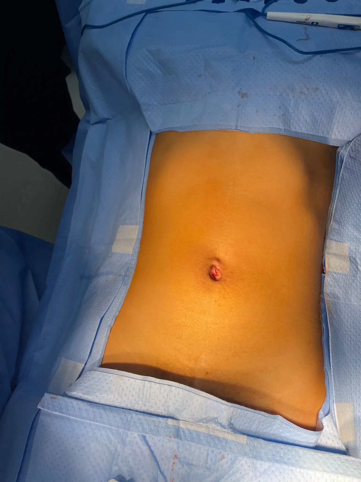 Ilustración de Apendicectomía Laparoscópica