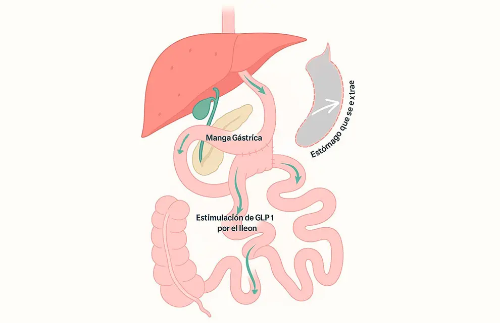 Ilustración de Bipartición Intestinal