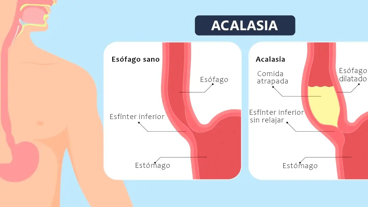 Ilustración de Cirugía para Acalasia