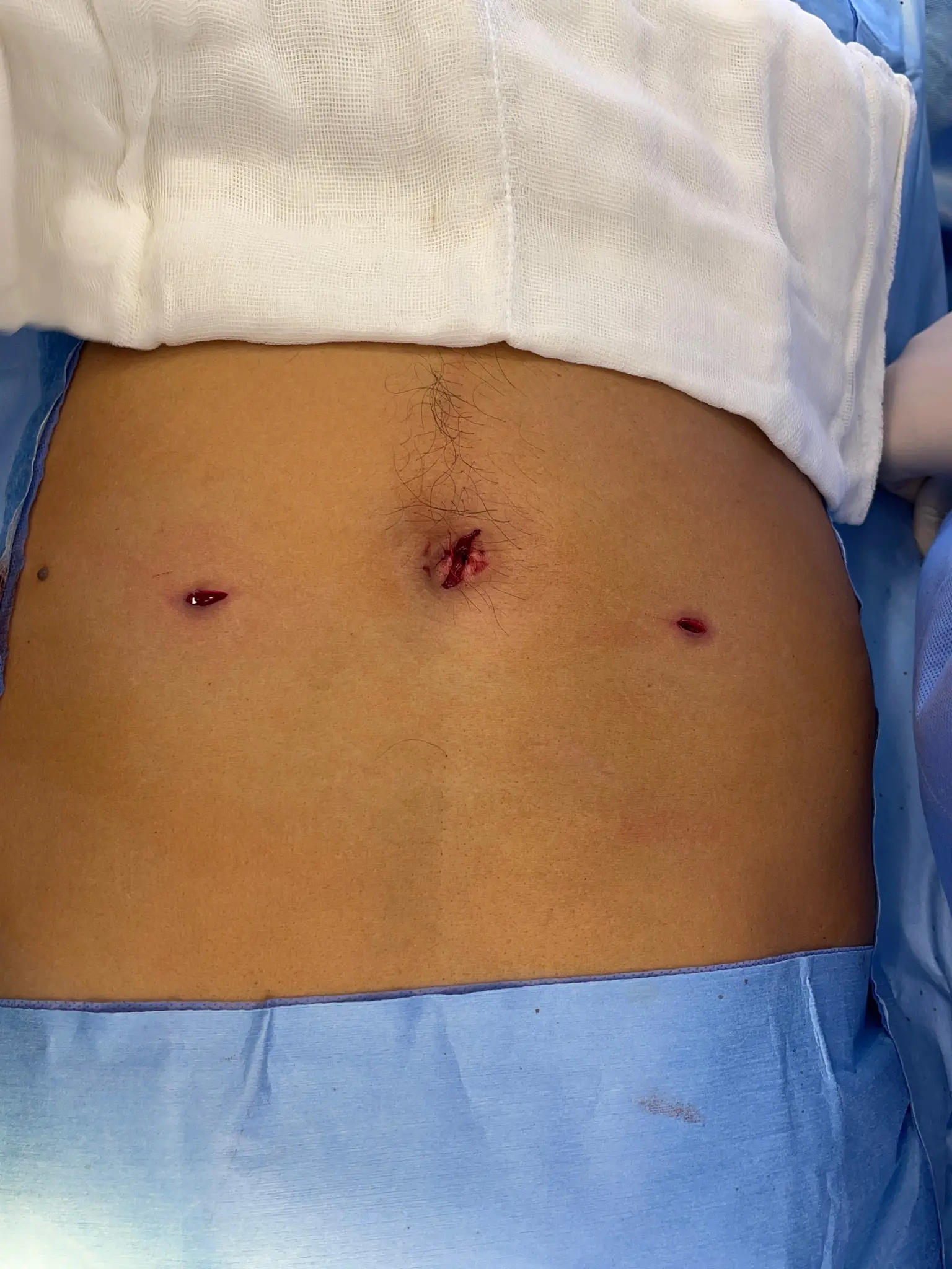 Ilustración de Hernias Inguinales