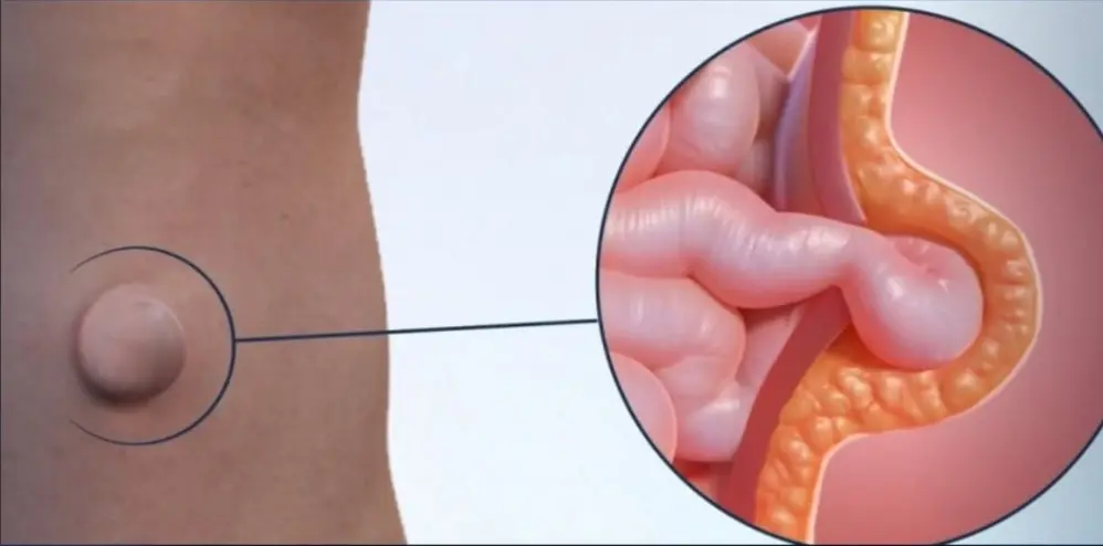 Ilustración de Hernias Ventrales