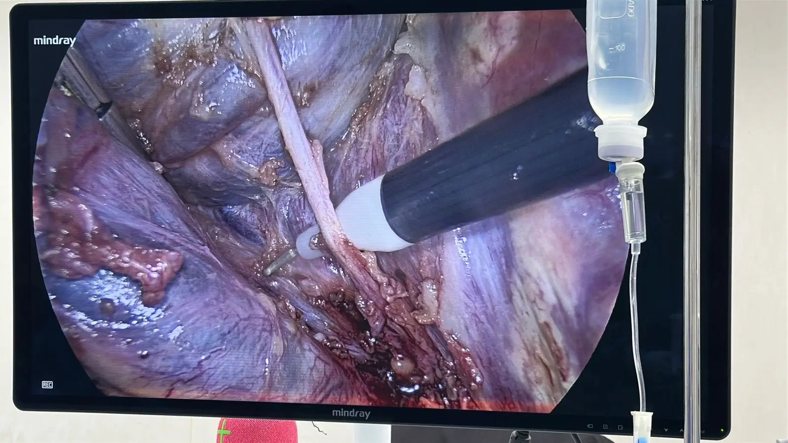 Ilustración de Colecistectomía Laparoscópica