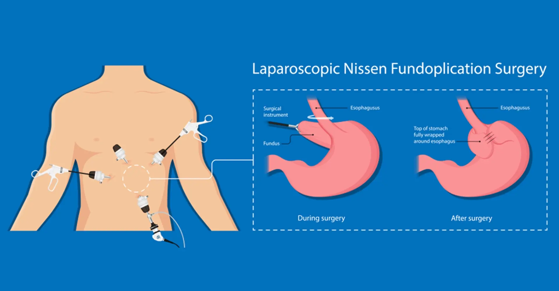 Ilustración de Funduplicatura